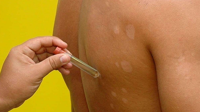 Prefeitura de Aracruz promoverá ação de combate à hanseníase no município